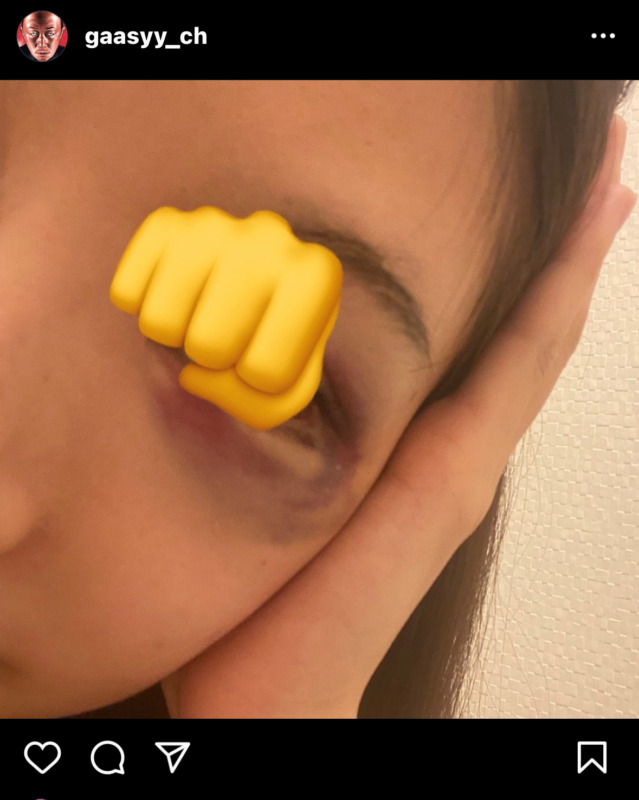 MCJ（マウスコンピュータ）高島会長の暴力被害者とされる女性の写真（目の周りにアザ）